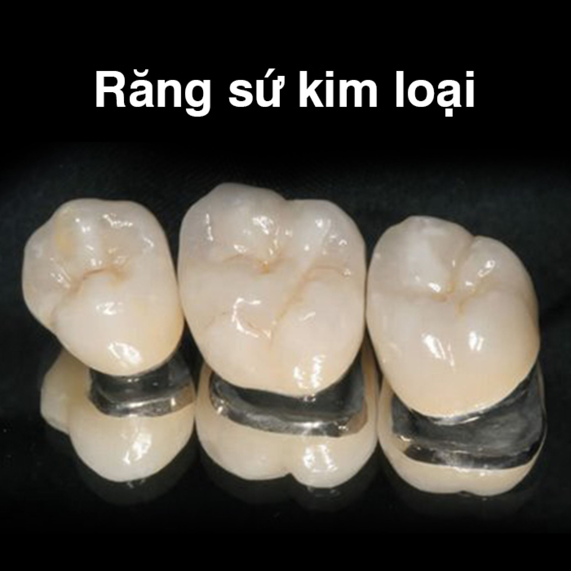 Răng sứ kim loại - Nha khoa Đức Nhân