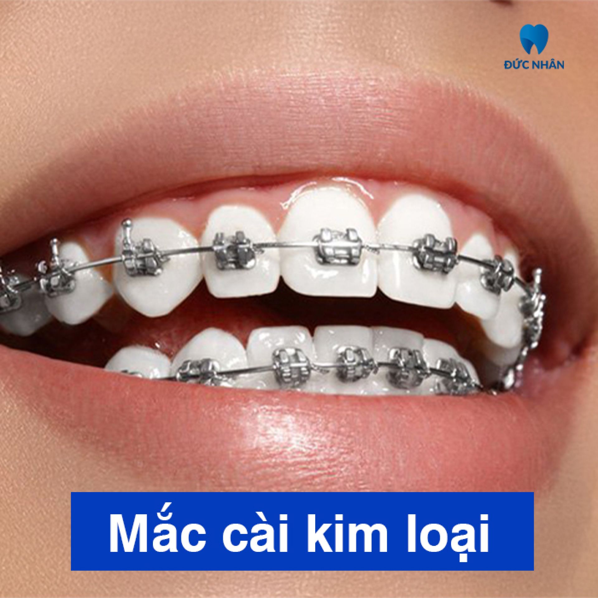 Niềng răng mắc cài kim loại tại Nha khoa Đức Nhân Biên Hòa