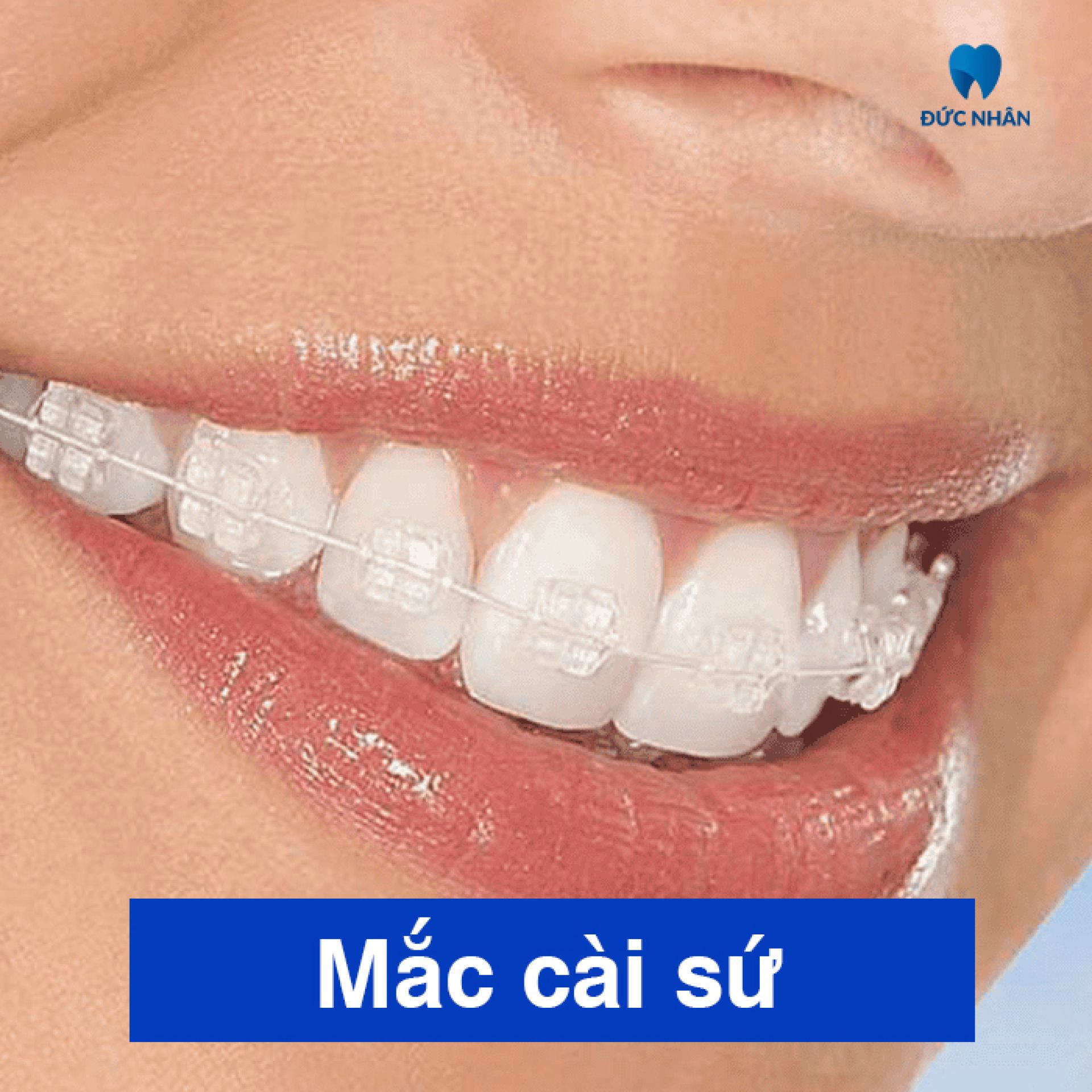 Niềng răng mắc cài sứ tại Nha khoa Đức Nhân Biên Hòa