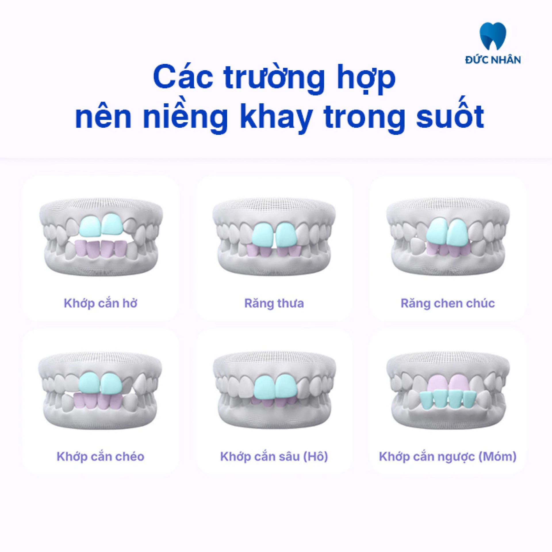 Những trường hợp nào nên niềng răng trong suốt?