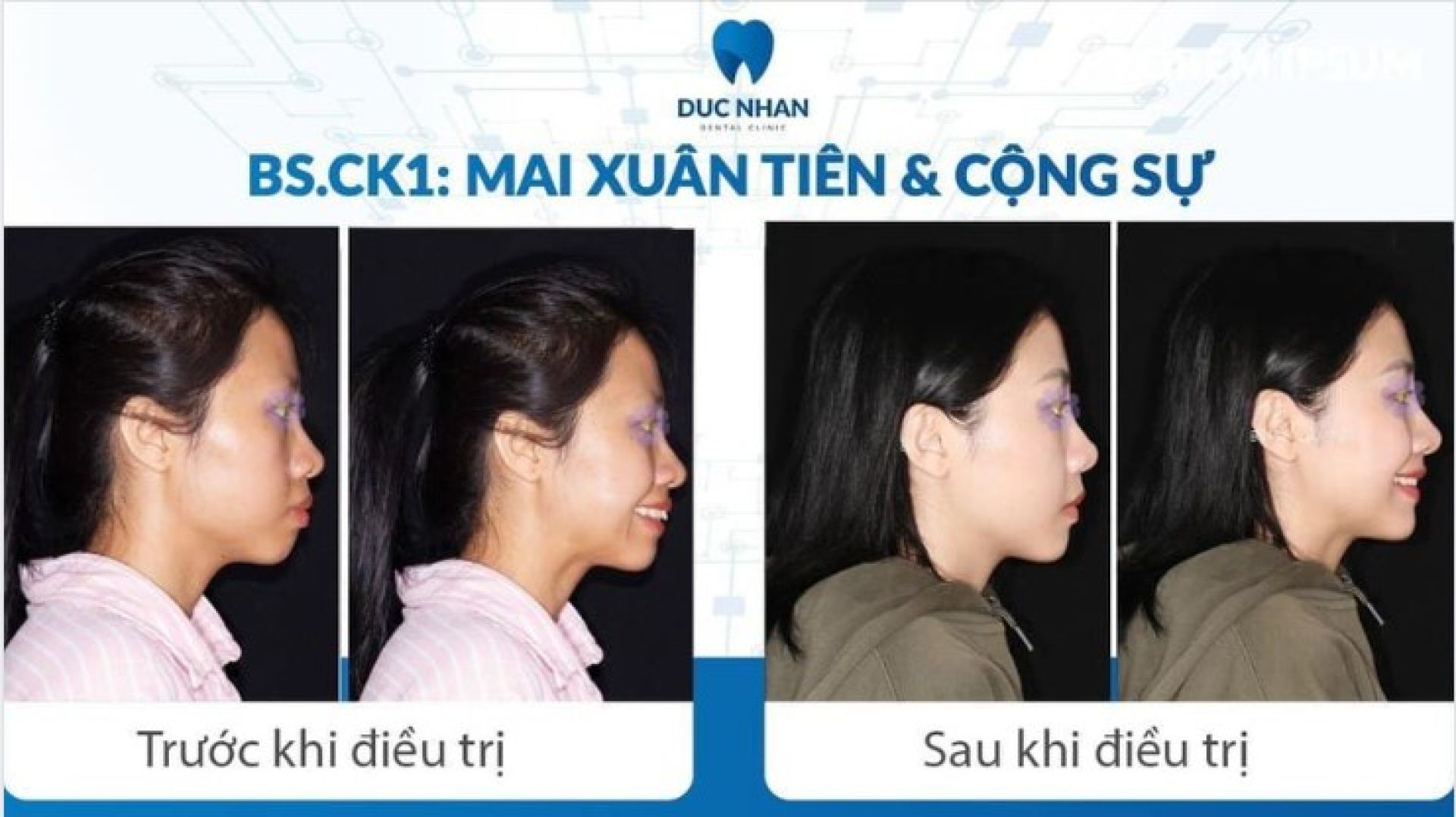 Khuôn mặt trước và sau khi niềng răng hô