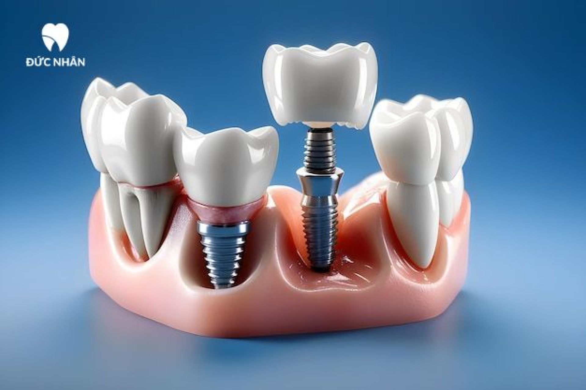 trồng răng implant dùng được bao lâu