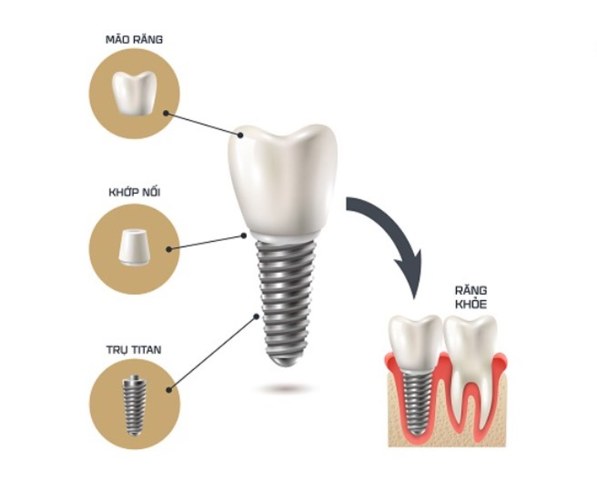 Trụ Implant là gì?