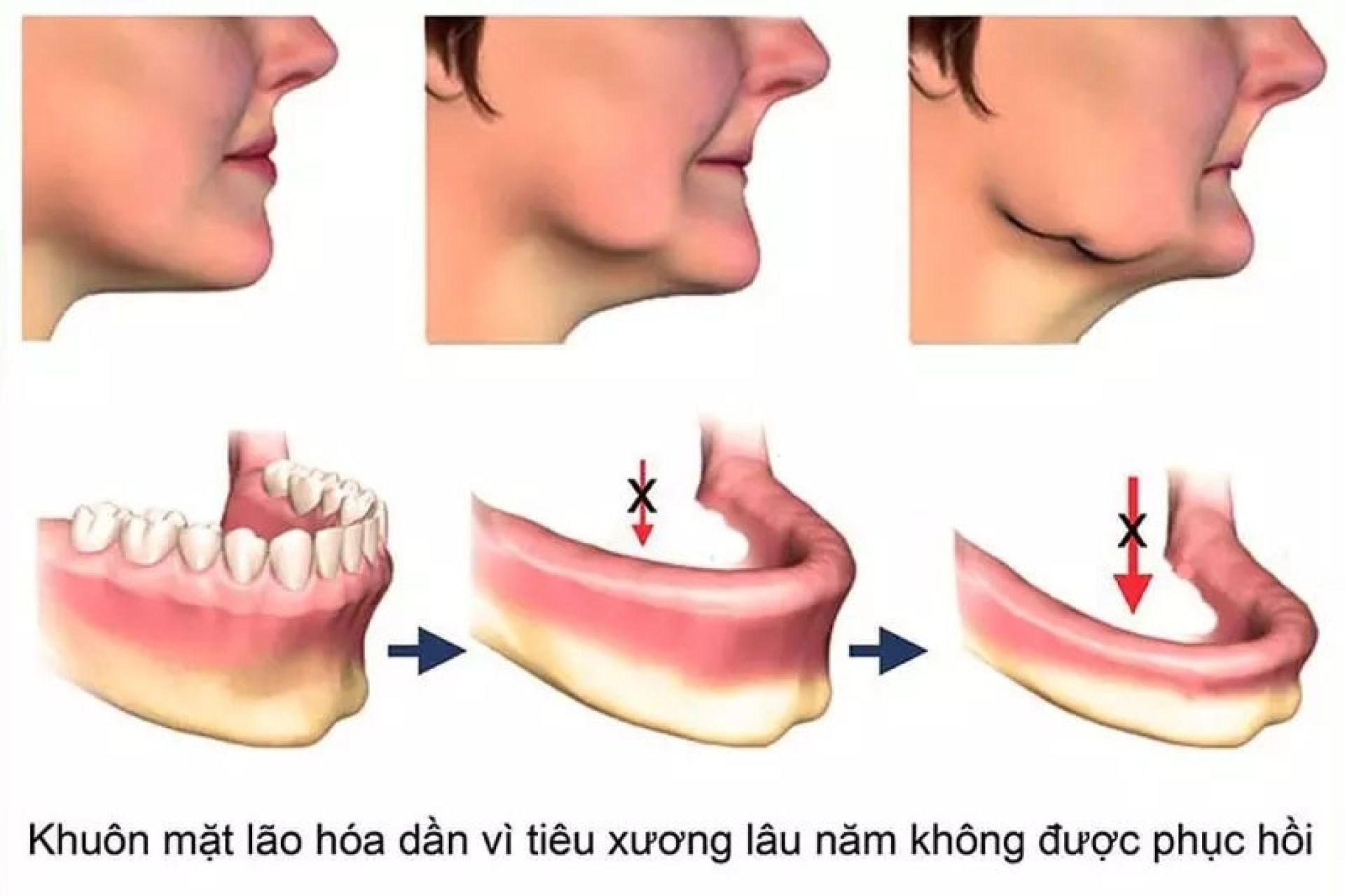 Vì sao mất răng nên trồng răng Implant