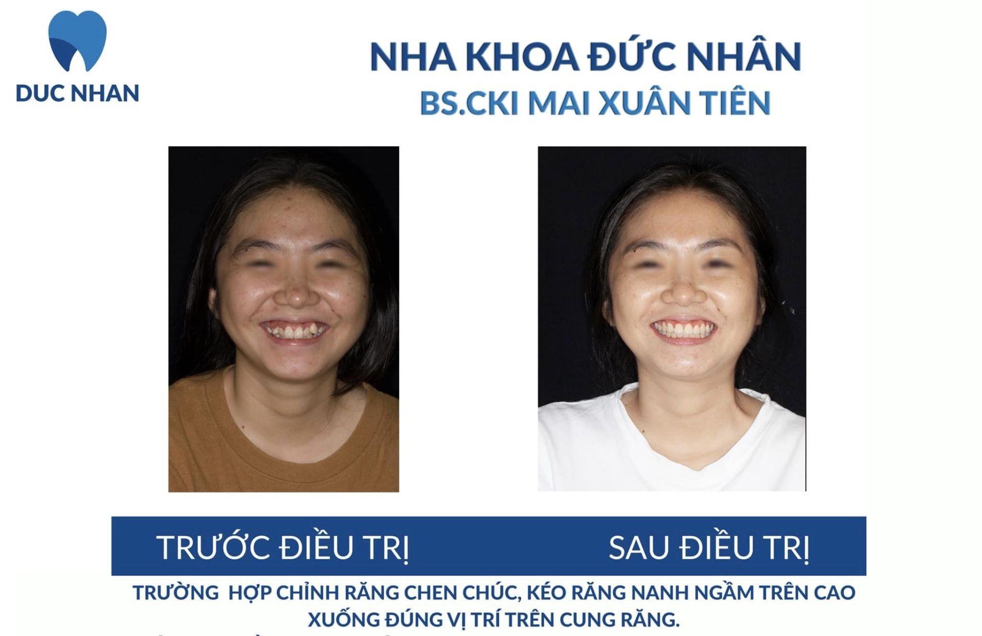 Trước và sau khi niềng răng chen chúc.