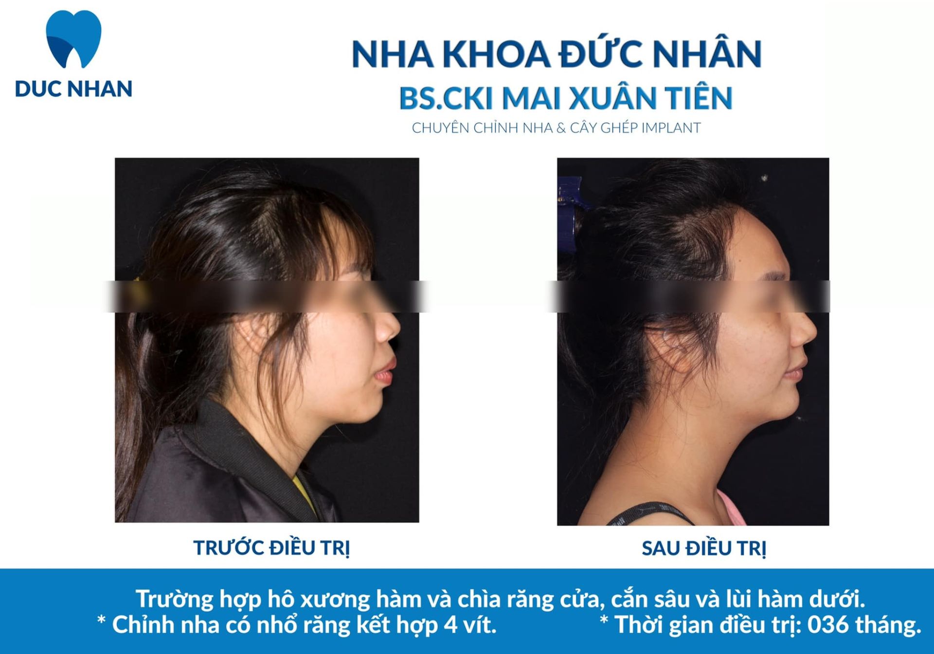 Trước và sau khi niềng răng hô xương hàm, chìa răng cửa, cắn sâu và lùi hàm dưới