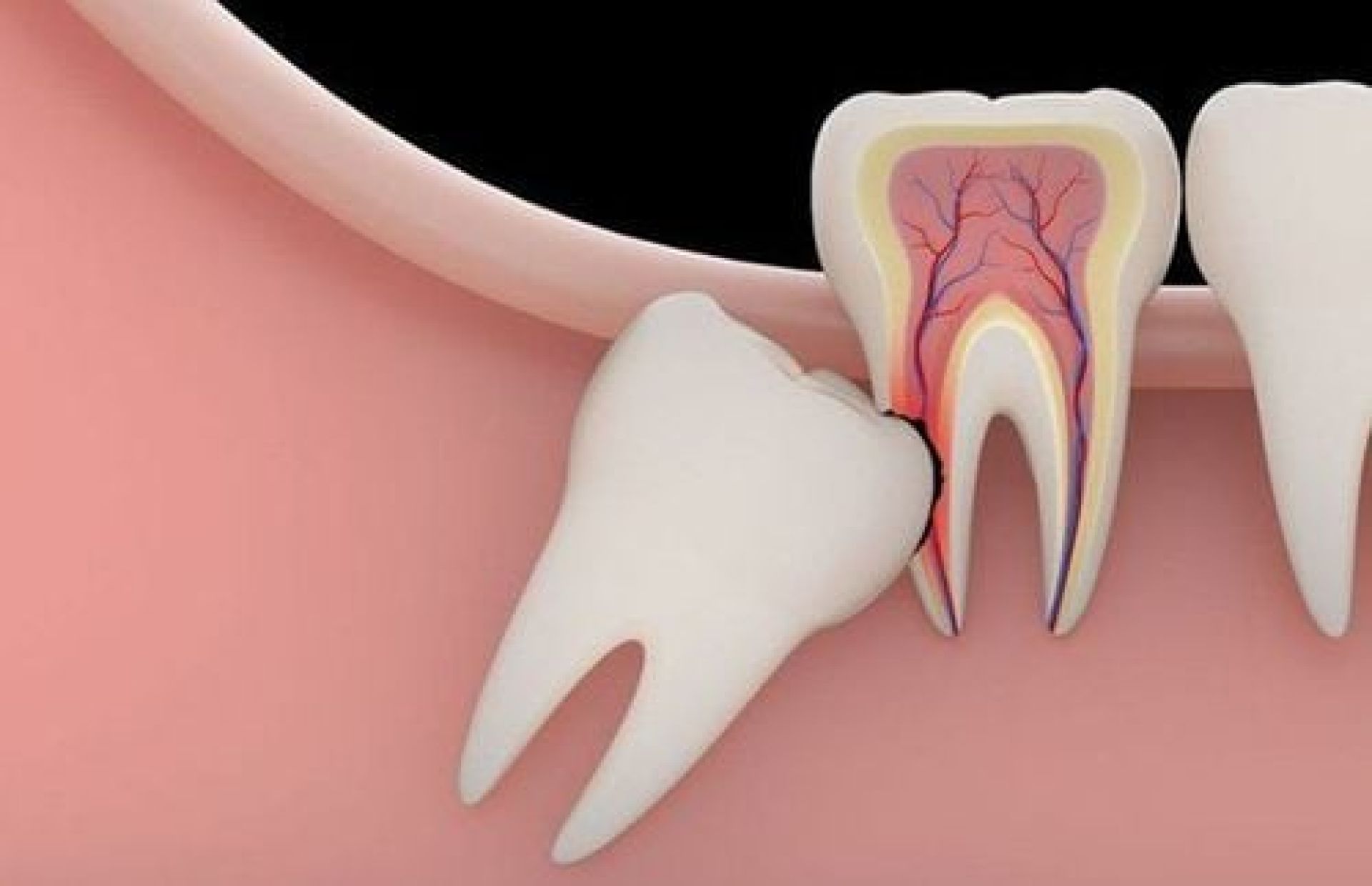 Tại sao răng khôn mọc lại gây đau - giải đáp từ Nha khoa Đức Nhân