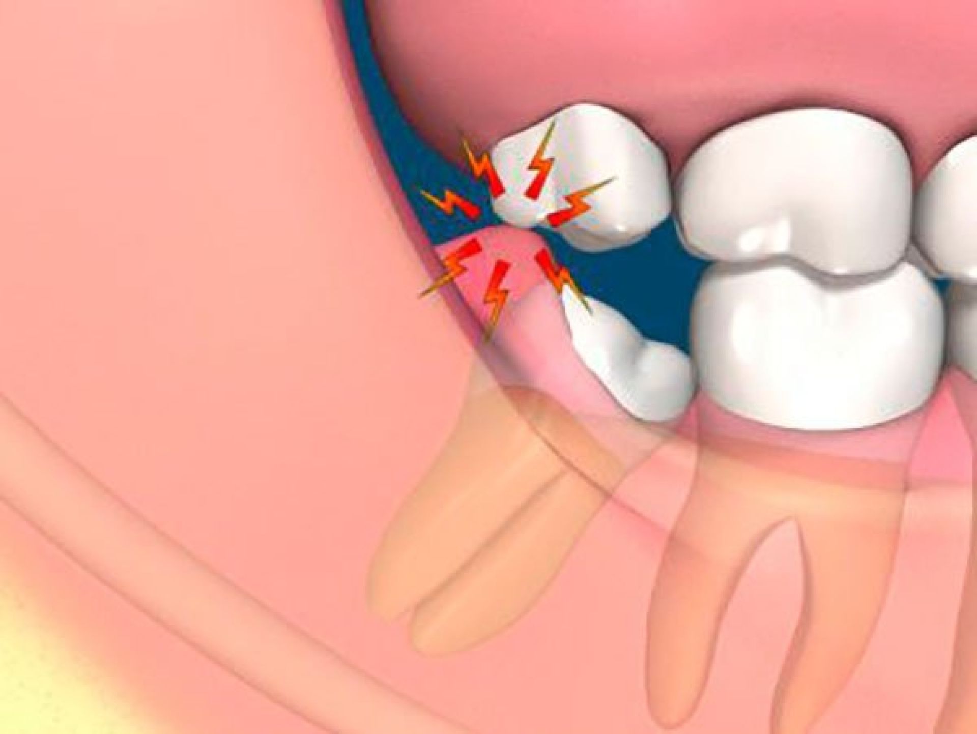 Mọc răng khôn đau mấy ngày thì hết