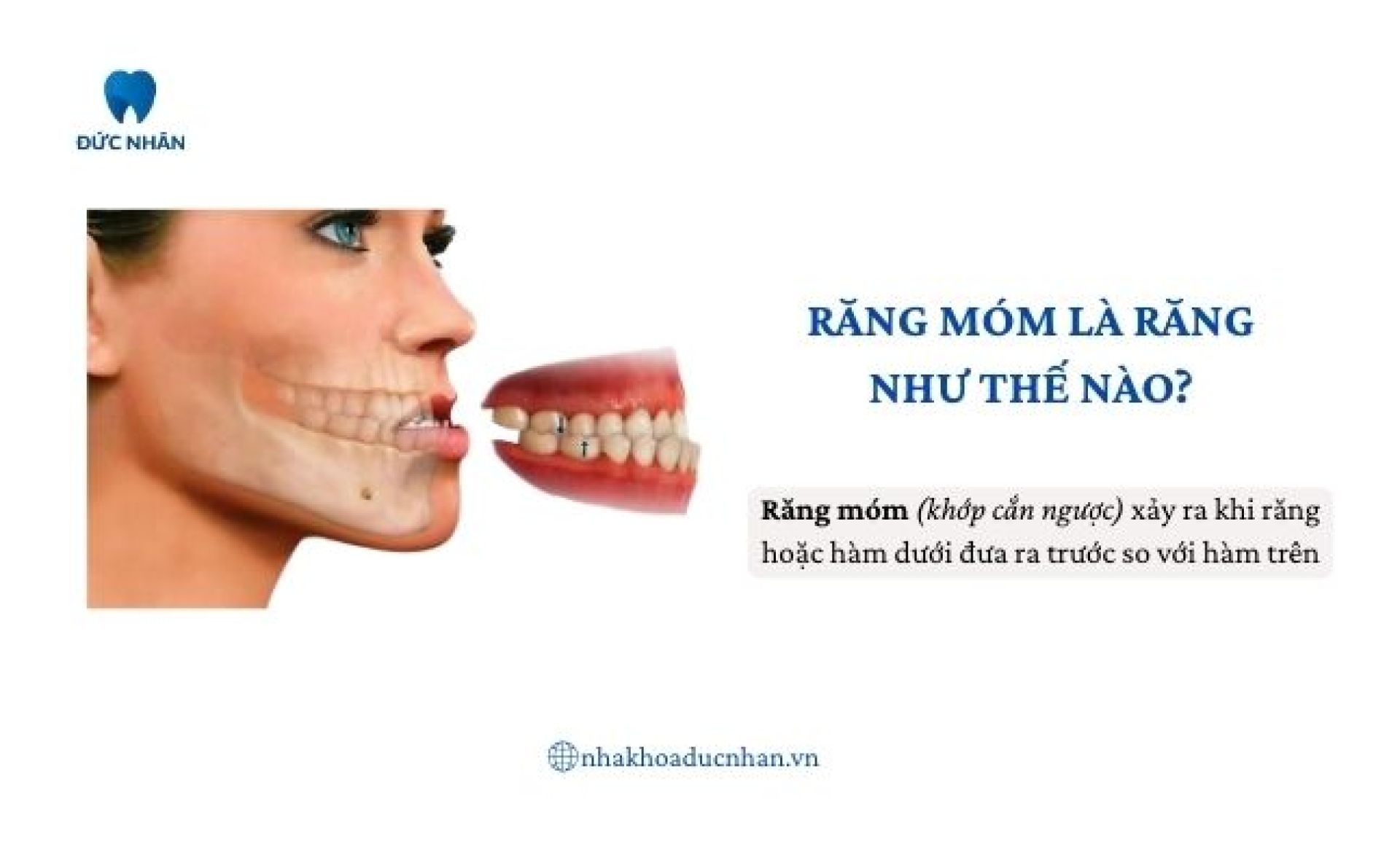 răng móm có niềng được không