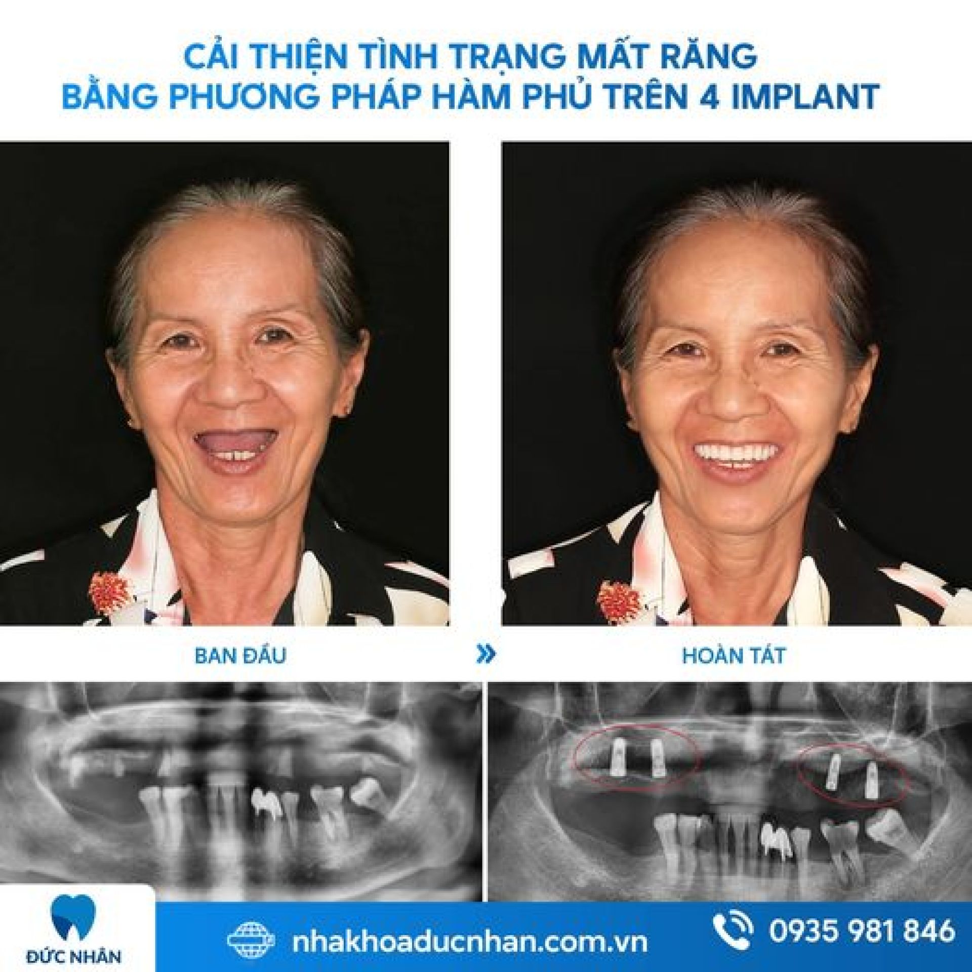 Khách hàng trồng răng Implant bằng máng định vị S-guide thành công tại Nha khoa Đức Nhân