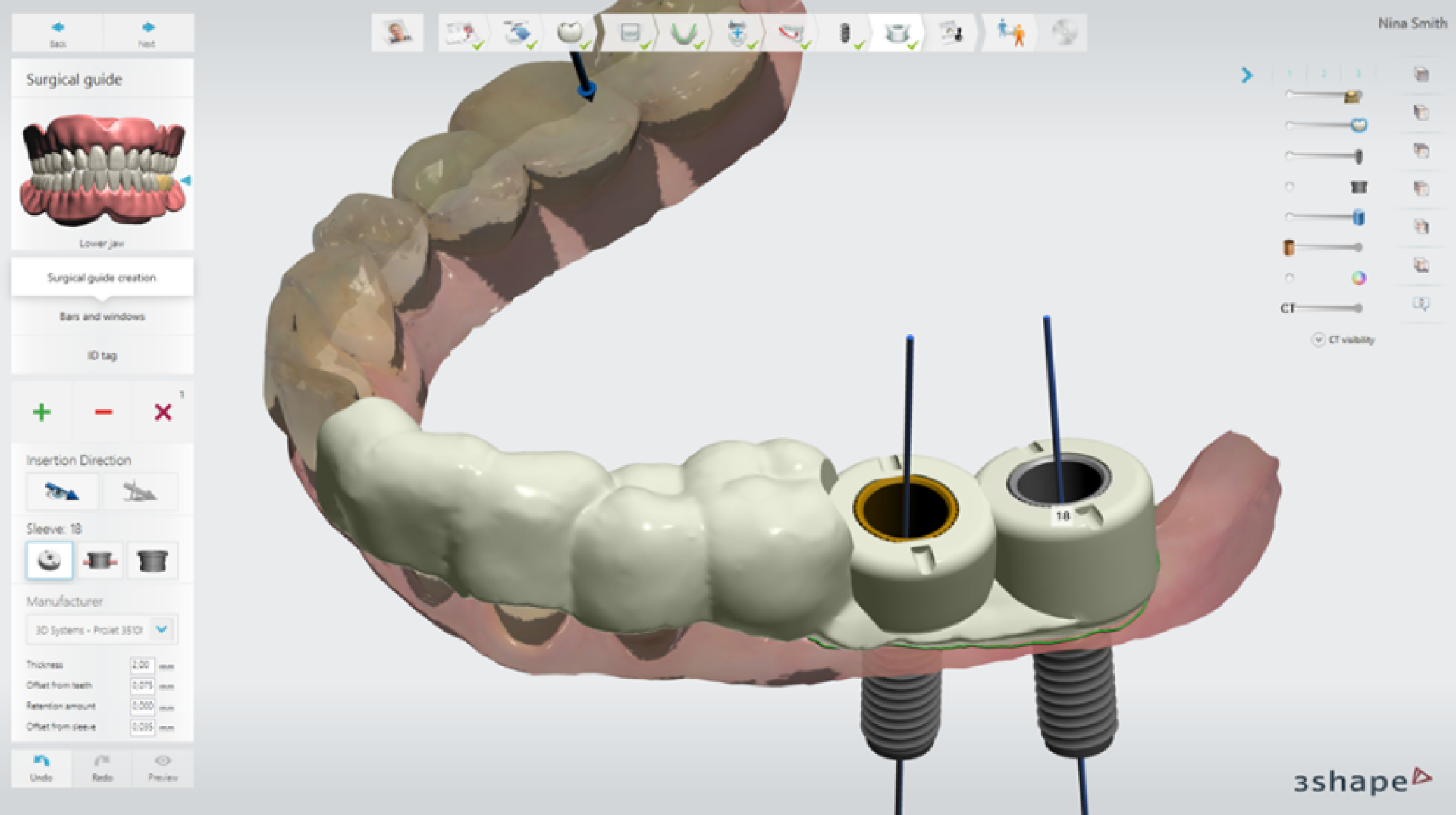 Máng S-guide là máng hướng dẫn phẫu thuật, được sử dụng khi cấy ghép Implant giúp Bác sĩ cắm Implant chính xác