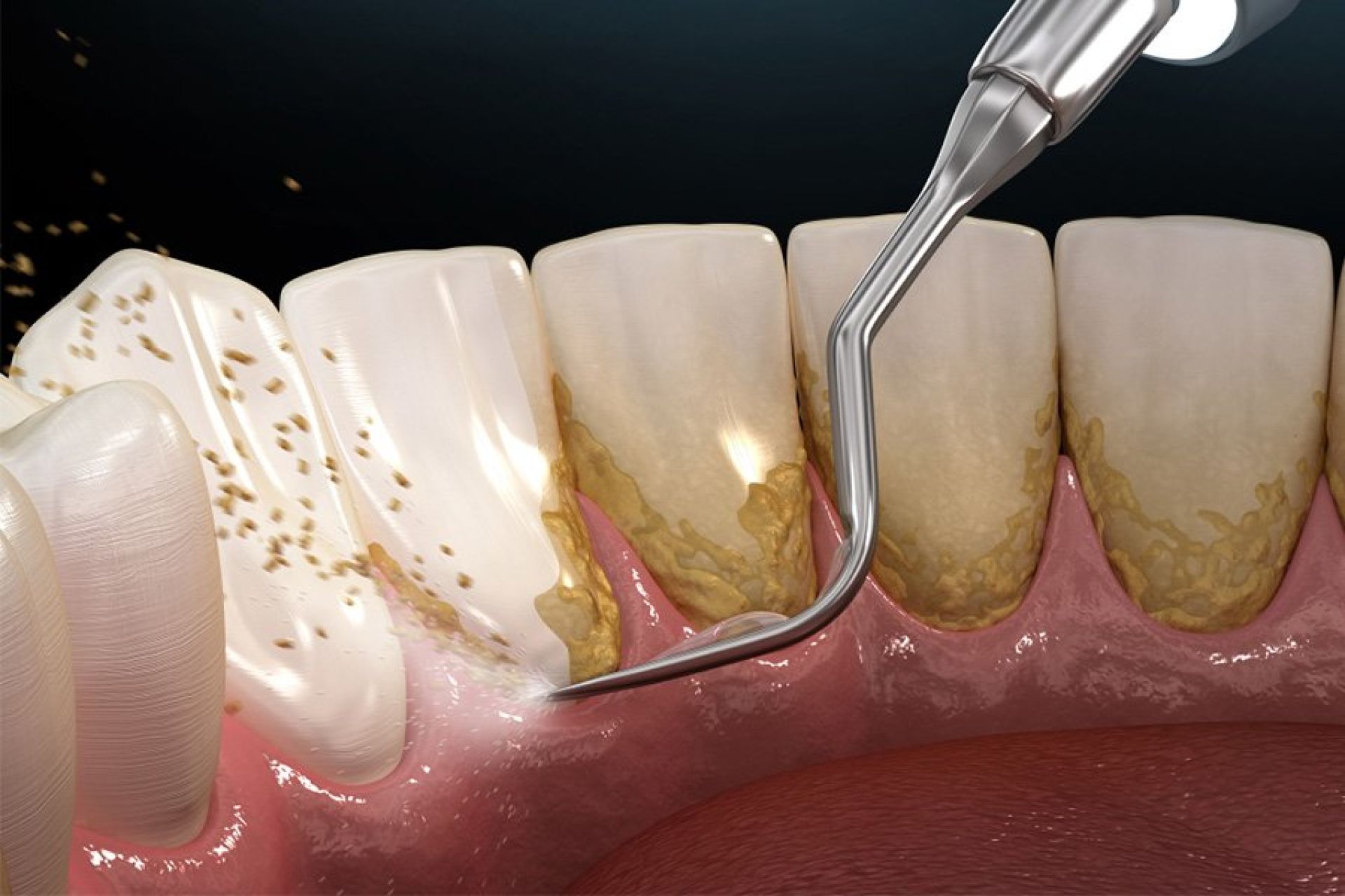 Thời điểm cạo vôi răng phù hợp, ngoài việc định kỳ 6 tháng 1 lần cạo vôi răng