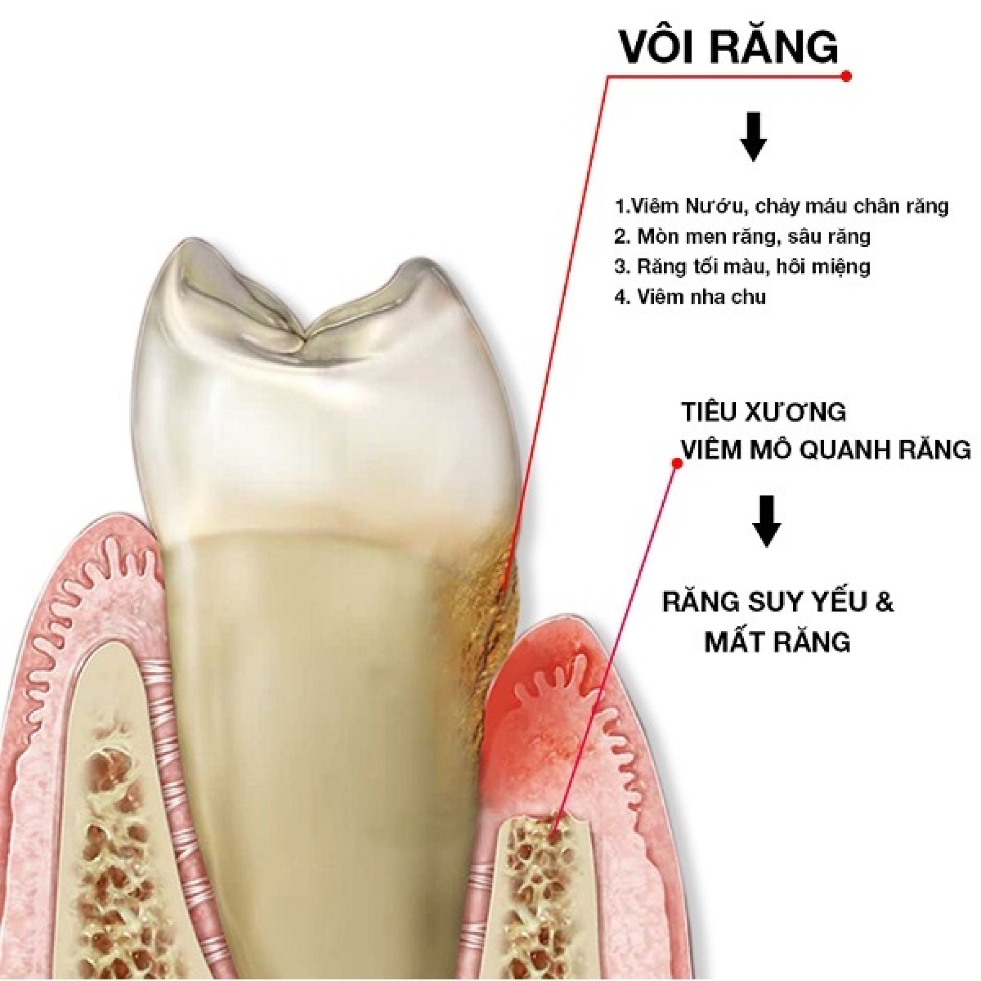 Vôi răng là gì và tác hại của vôi răng - lý do bạn nên cạo vôi răng định kỳ